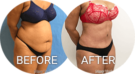 Ozempic vs. VASER Liposuction: Here's How to Choose - 360 Plastic Surgery