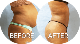 Best Liposuction Manhattan, Long Island