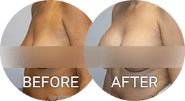 before after photos breast augmentation