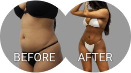 before after photos tummy tuck