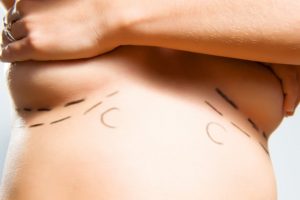 How Your Cosmetic Surgeon Minimizes Your Risk of Capsular Contracture