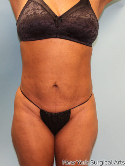 brazilian butt lift before and after