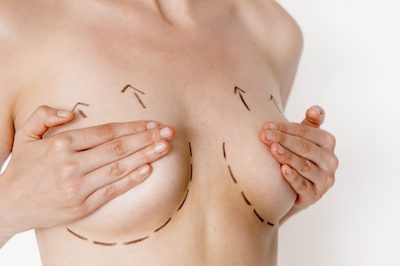 Breast Lift Recovery and Results