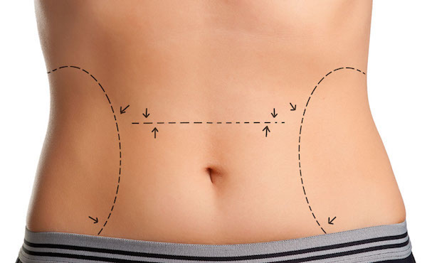 Your Tummy Tuck Procedure