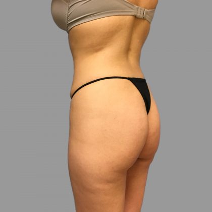 Brazilian Butt Lift Before & After Patient #1421