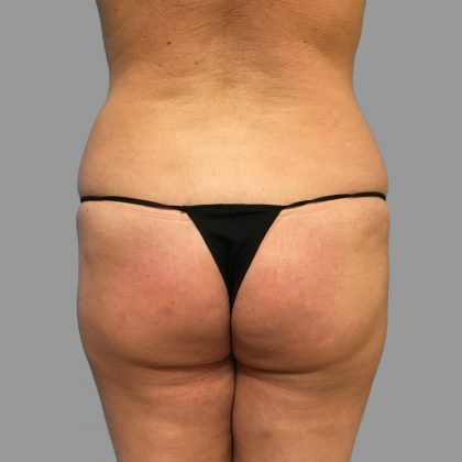 Brazilian Butt Lift Before & After Patient #1453