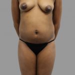 Breast Augmentation Before & After Patient #1476