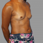 Breast Augmentation Before & After Patient #1462