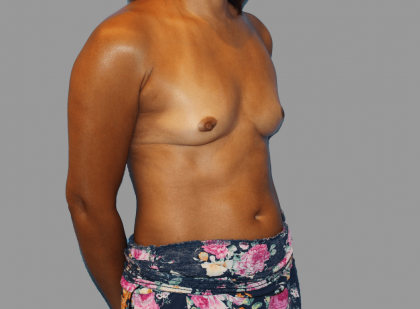 Breast Augmentation Before & After Patient #1462
