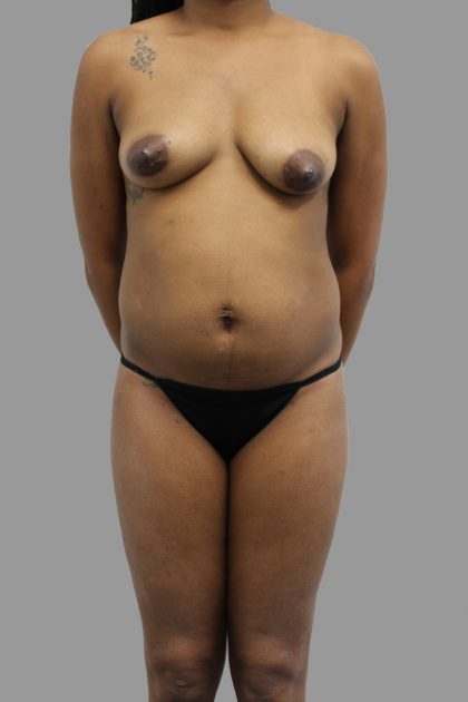 Breast Augmentation Before & After Patient #1476