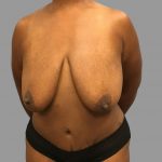 Breast Lift Before & After Patient #1479