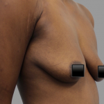 Breast Augmentation Before & After Patient #1470