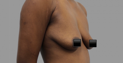 Breast Augmentation Before & After Patient #1470