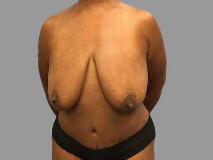 Breast Lift Before & After Patient #1479