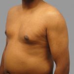 Gynecomastia Before & After Patient #1504