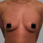 Breast Augmentation Before & After Patient #1473