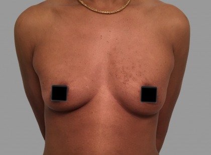 Breast Augmentation Before & After Patient #1473