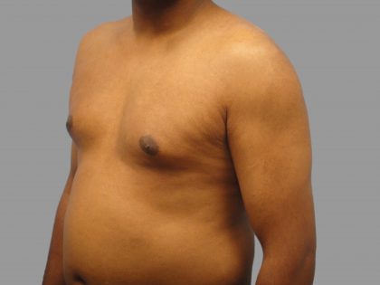 Gynecomastia Before & After Patient #1504