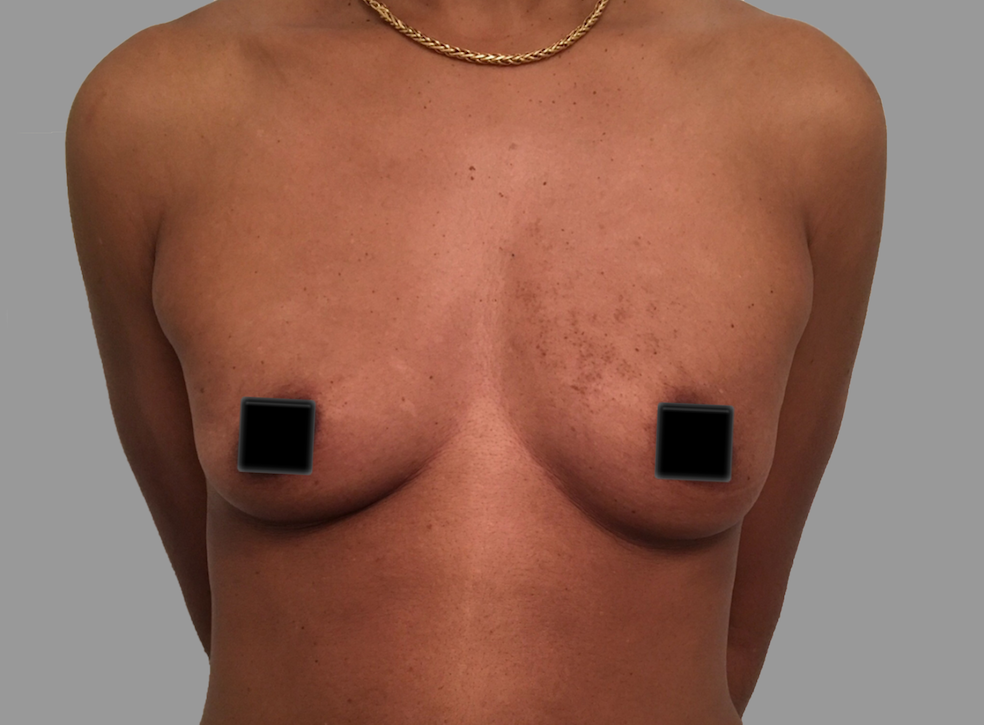 Breast Augmentation Before & After Patient #1473