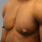 Gynecomastia Before & After Patient #1507