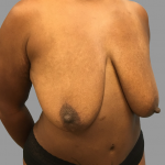 Breast Lift Before & After Patient #1479