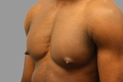 Gynecomastia Before & After Patient #1507