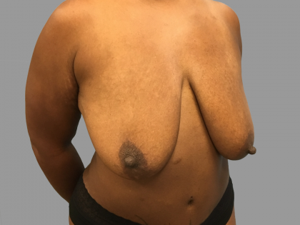 Breast Lift Before & After Patient #1479