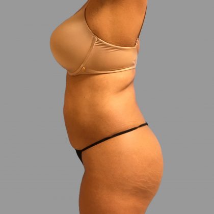 Liposuction Before & After Patient #1523