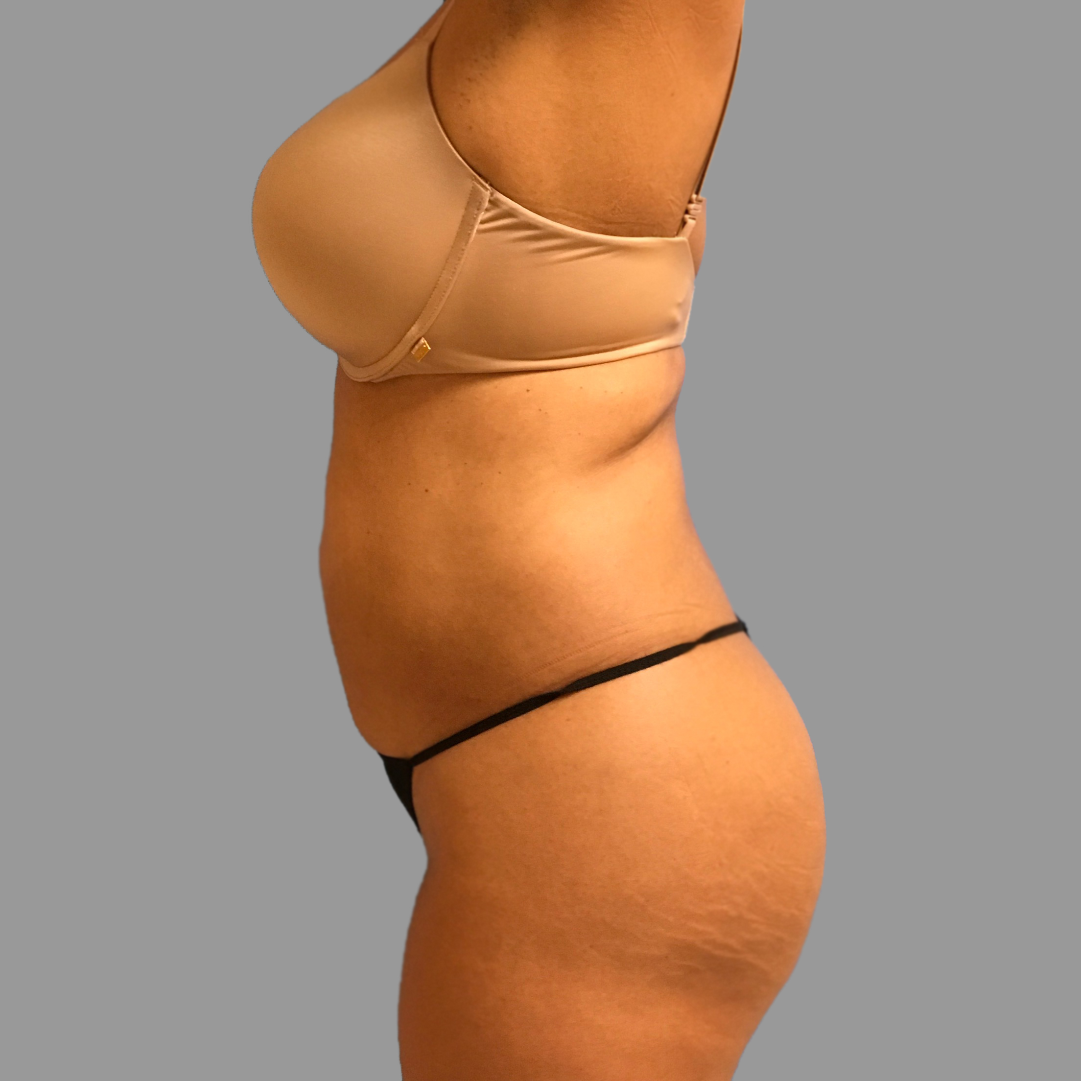 Liposuction Before & After Patient #1523