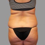 Liposuction Before & After Patient #1529