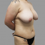 Breast Lift Before & After Patient #1490