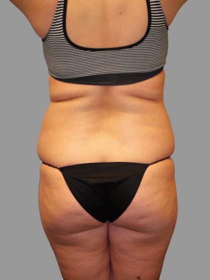 Liposuction Before & After Patient #1529