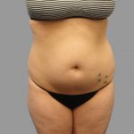 Liposuction Before & After Patient #1529