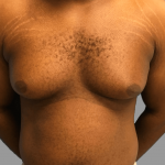 Gynecomastia Before & After Patient #1493