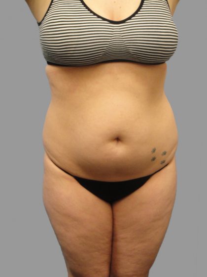 Liposuction Before & After Patient #1529