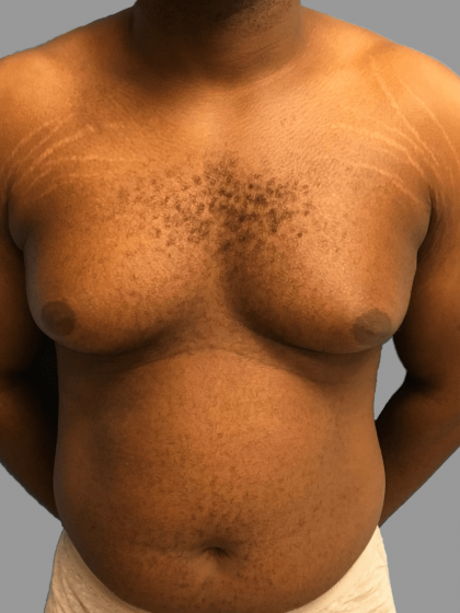 Gynecomastia Before & After Patient #1493