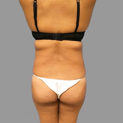 Brazilian Butt Lift Before & After Patient #1426