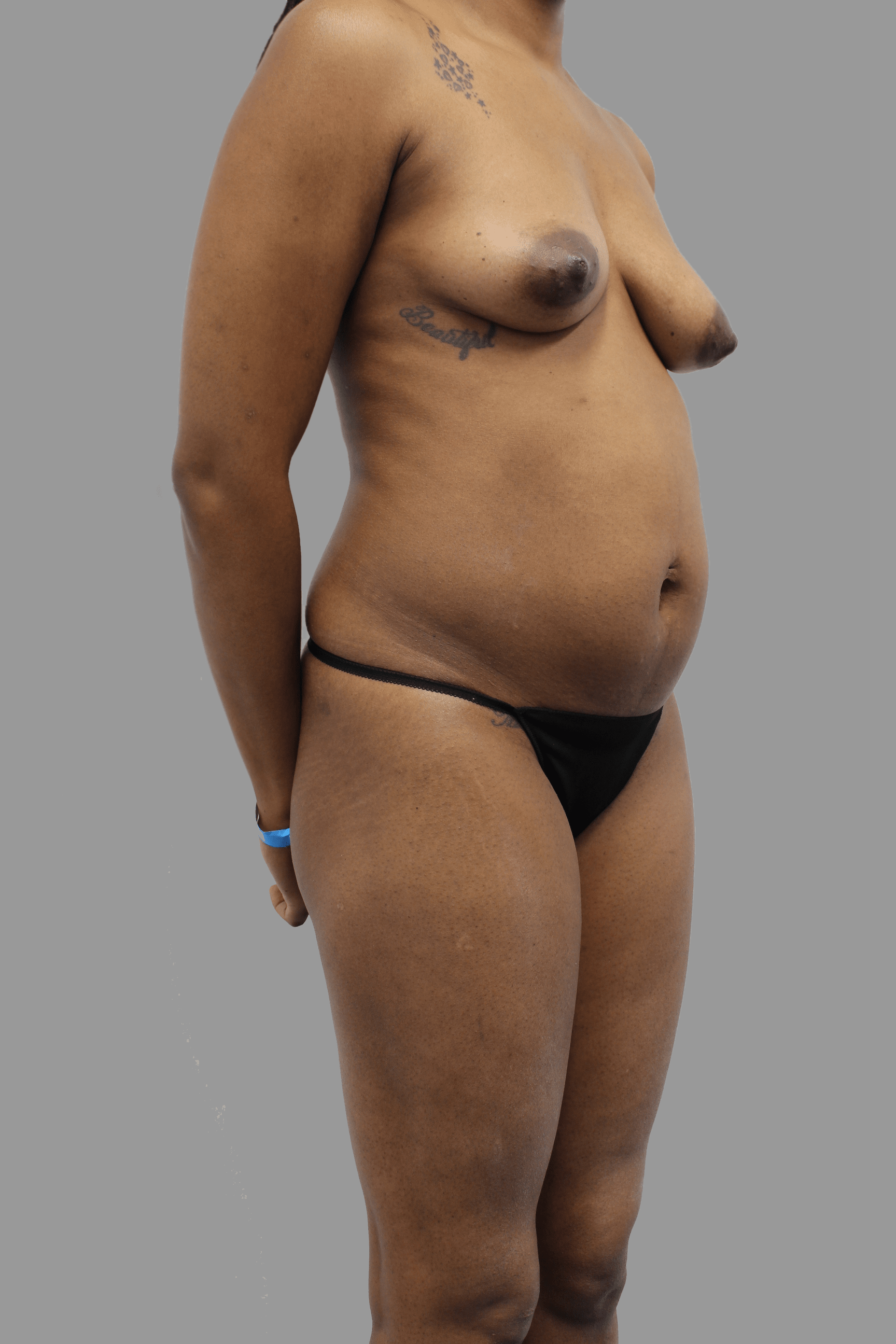 Abdominal Etching Before & After Patient #1407