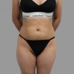 Liposuction Before & After Patient #1548
