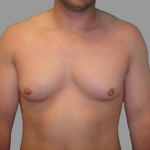 Gynecomastia Before & After Patient #1496