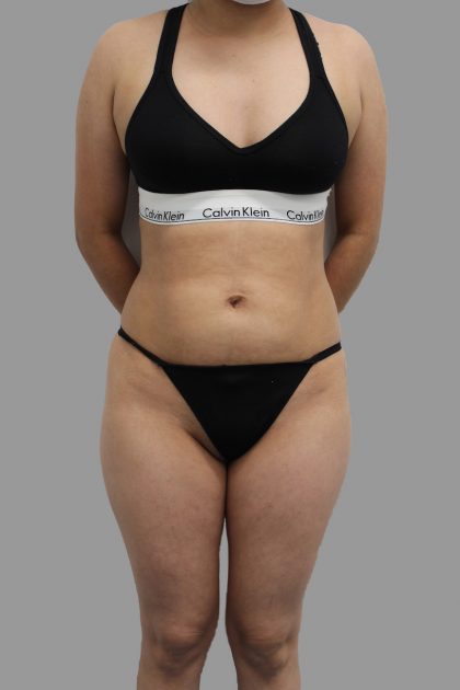 Liposuction Before & After Patient #1548