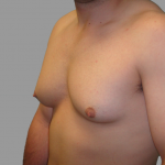 Gynecomastia Before & After Patient #1496