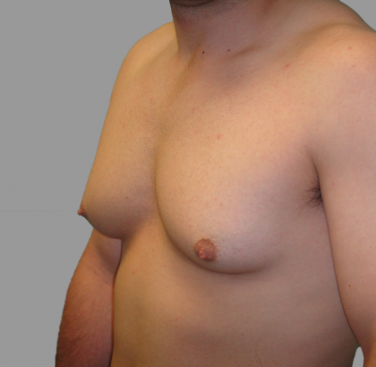Gynecomastia Before & After Patient #1496