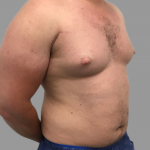 Gynecomastia Before & After Patient #1501