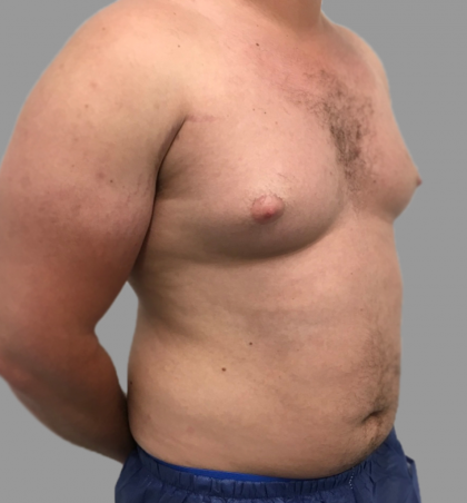 Gynecomastia Before & After Patient #1501