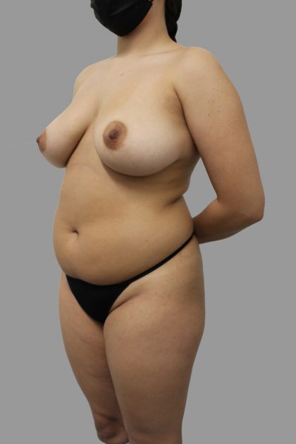 Liposuction Before & After Patient #1553