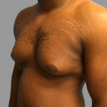 Gynecomastia Before & After Patient #1510