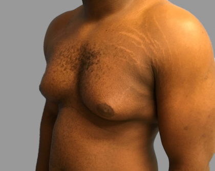 Gynecomastia Before & After Patient #1510