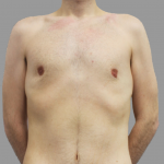 VASER Hi Def Lipo Before & After Patient #1513