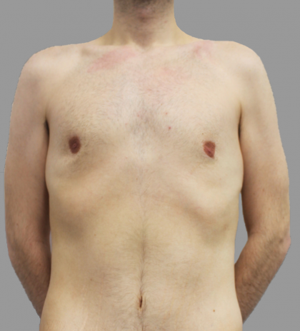 VASER Hi Def Lipo Before & After Patient #1513